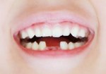 Front-tooth-20130907.jpg